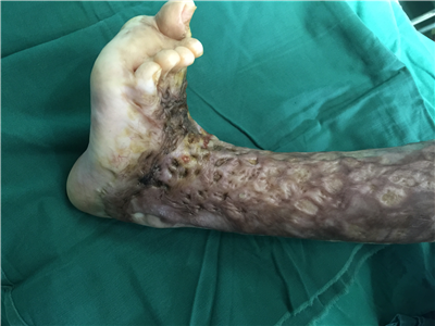 救助过程: (1)2015年7月27日,患儿因全身烧伤治愈后瘢痕挛缩畸形6月余